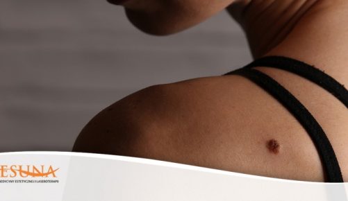 Zmiany skórne, których nie warto się bać